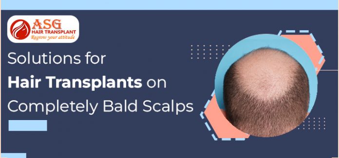 Solutions-for-Hair-Transplants-on-Completely-Bald-Scalps