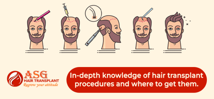 In-depth knowledge of hair transplant procedures and where to get them.