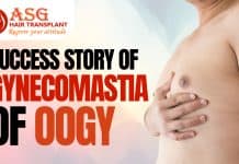 Success story of Gynecomastia