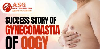 Success story of Gynecomastia