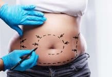 Liposuction Surgery: Procedure, Complications and Its Results