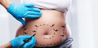 Liposuction Surgery: Procedure, Complications and Its Results