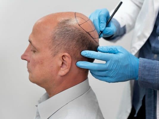 All about the after-period of the hair-transplantation