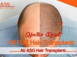 Effective Result Of FUE Hair Transplant At ASG Hair Transplant
