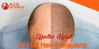 Effective Result Of FUE Hair Transplant At ASG Hair Transplant