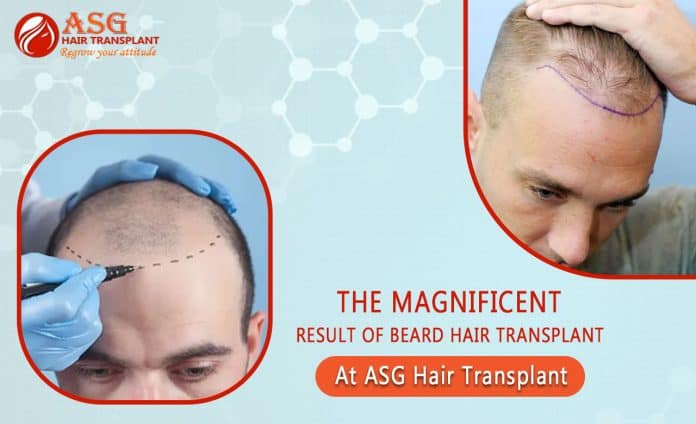 The Magnificent Result Of Beard Hair Transplant At ASG Hair Transplant