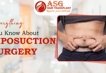 Everything You Know About Liposuction Surgery