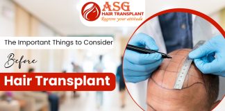 The Important Things to Consider Before Hair Transplant