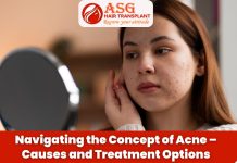 Navigating the Concept of Acne - Causes and Treatment Options