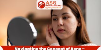 Navigating the Concept of Acne - Causes and Treatment Options