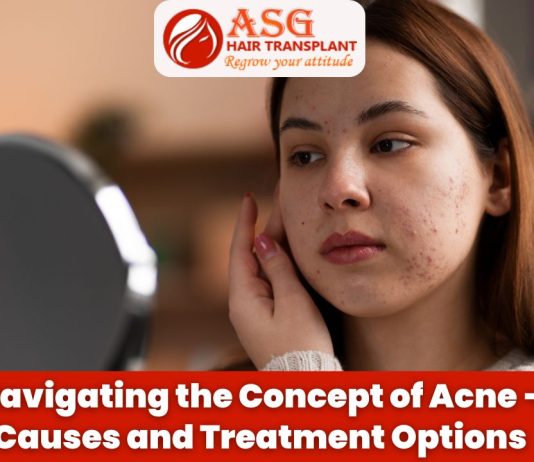 Navigating the Concept of Acne - Causes and Treatment Options