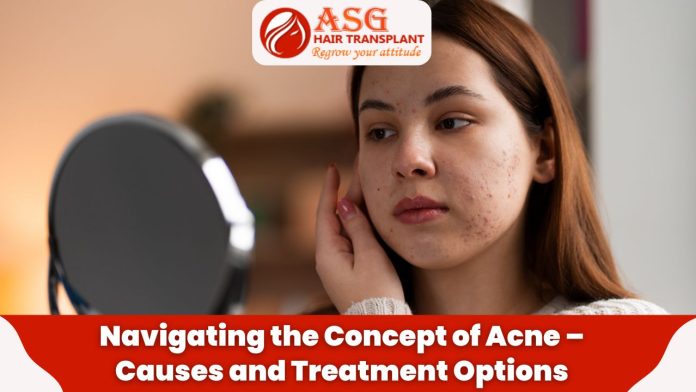 Navigating the Concept of Acne - Causes and Treatment Options