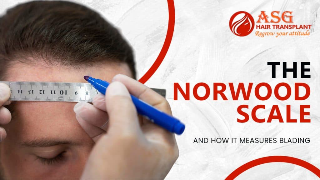 Understanding the Norwood Scale