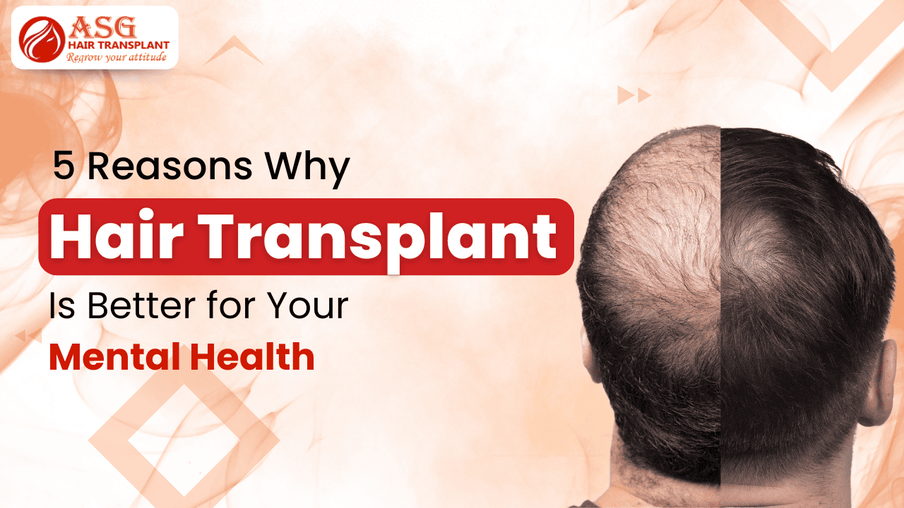 5 Reasons Why Hair Transplant Is Better for Your Mental Health