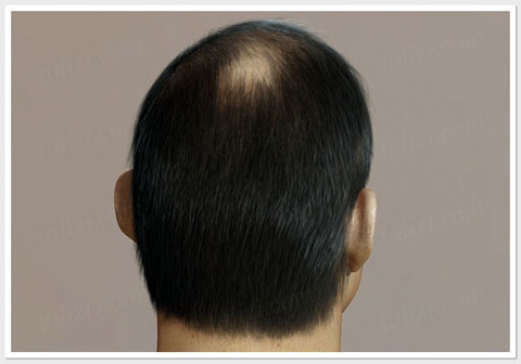 Male pattern baldness back view - ASG Hair Transplant Centre