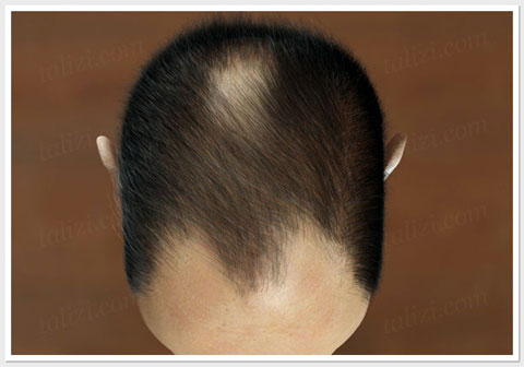 Male pattern baldness Type 1 - ASG Hair Transplant Centre