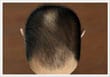 male Baldness Type 3 - ASG Hair Transplant Centre