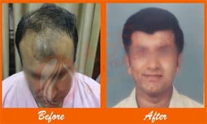 3 Result hair loss Treatment