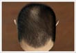 male Baldness Type 1- ASG Hair Transplant Centre