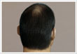 Male pattern baldness Type 3s - ASG Hair Transplant Centre