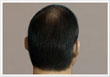 Male pattern baldness Type 4s - ASG Hair Transplant Centre
