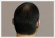 Male pattern baldness Type 5 - ASG Hair Transplant Centre