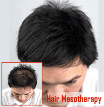Hair-Mesotherapy