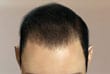 after-1000-grafts-s - ASG Hair Transplant Centre