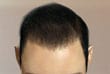 after-1500-grafts-s - ASG Hair Transplant Centre