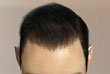 after-2000-grafts-s - ASG Hair Transplant Centre