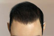 after-2500-grafts-s - ASG Hair Transplant Centre