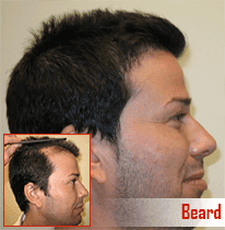 beard-hair-transplant