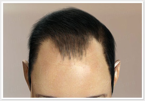 Hair Loss level 3 - ASG Hair Transplant Centre