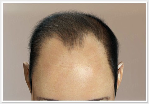 Hair Loss level 4 - ASG Hair Transplant Centre