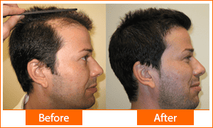 1 Hair transplant Successful Results