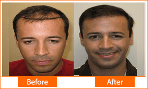 2 Hair transplant Successful Results