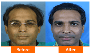 4 Hair transplant Successful Results