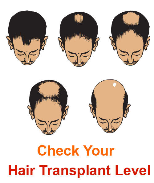 check hair loss stages
