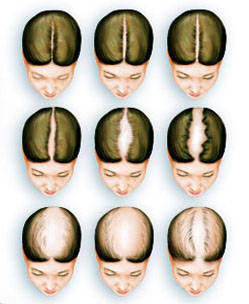 Hair Transplant in women, its procedure and Techniques available.