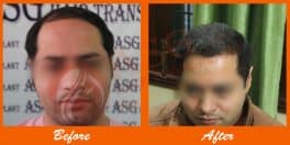Hair Transplant Cost In India, Cost of Hair transplant in Punjab, Ludhiana,  Jalandhar