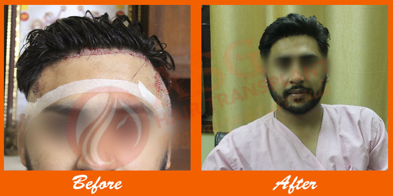 Hair Transplant Cost Asghairtransplant  Jalandhar  Clickin