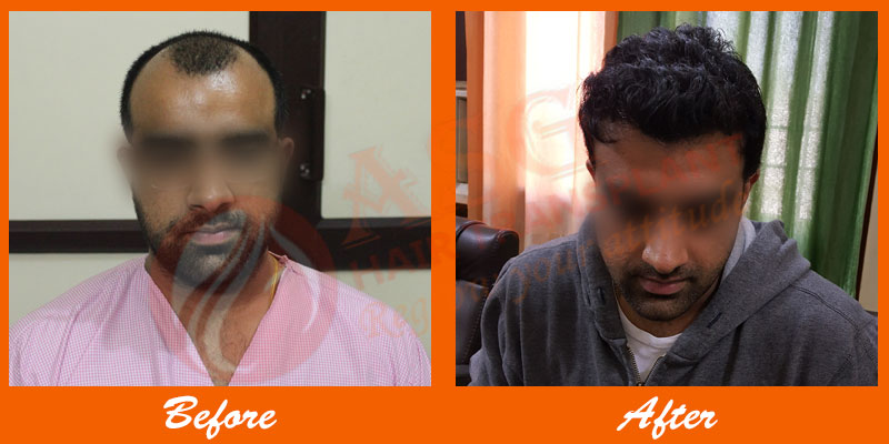 Hair Transplant Before After Pictures